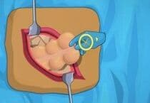 Operate Now : Chirurgie de l'Appendicite