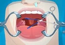 Tonsil Surgery